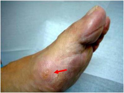 Plantar pressures values related with appearance of mechanical hyperkeratosis before and after surgery of mild hallux valgus